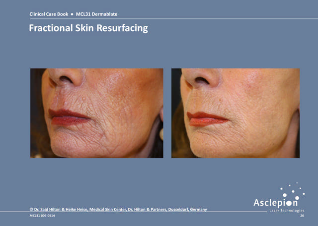Ablativ & Fractional Skin Rejuvenation