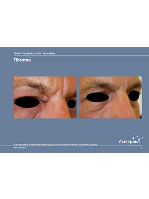 Dermal & Epidermal lesions