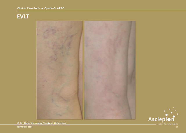 Endovascular Laser Therapy (EVLT)