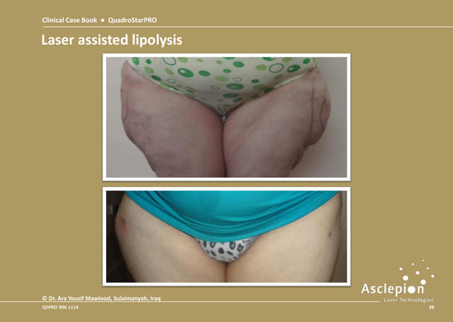 Laser Assissted Lipolysis