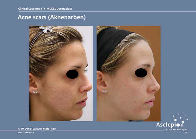 Scar treatment