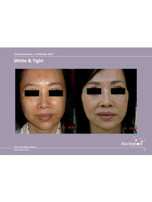 Skin Tightening & Wrinkle Reduction